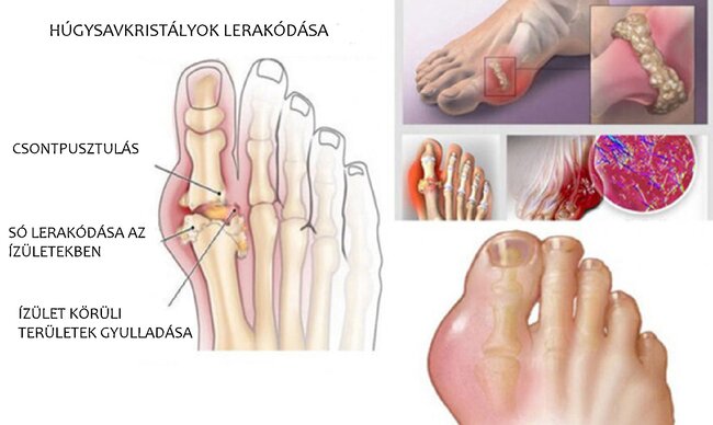 Ízületi porc és ízületi szerkezet anatómiai ábrája, az ízületek működésének bemutatása