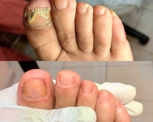 Bőrgomba tünetei a bőrön