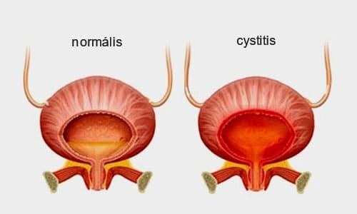 A hólyaghurut fő oka a hólyag gyulladása, amelyet leggyakrabban bakteriális fertőzés okoz
